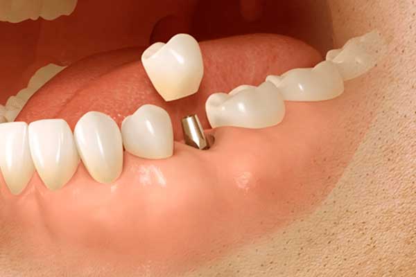 Immediate Implant Treatment in Turkey