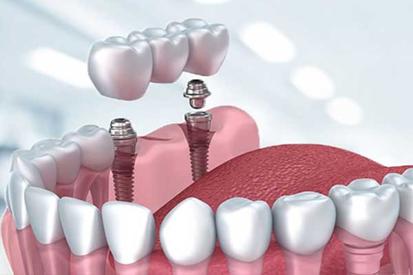 dental implants turkey