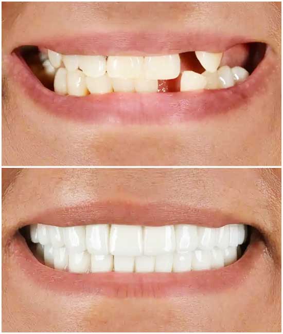 before and after dental photos