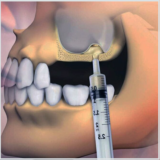 Sinus Lifting in Turkey