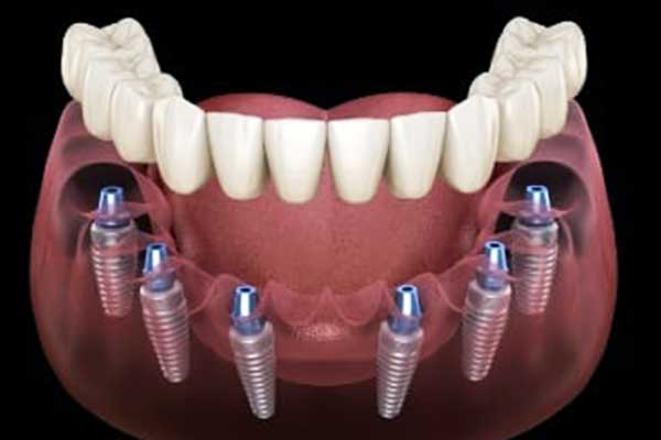 all inclusive dental implants turkey