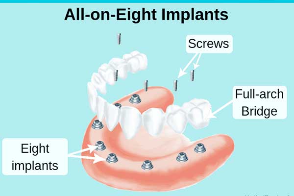 all on 8 dental implants turkey