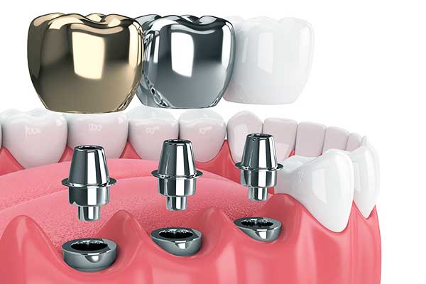 best dental implants in turkey cost