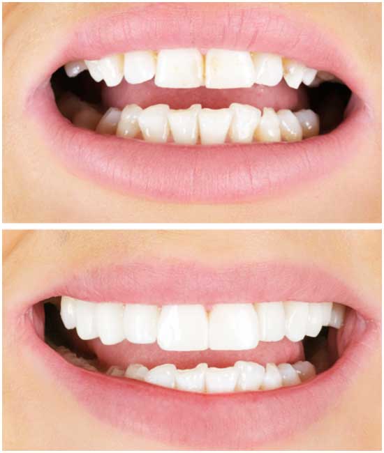 before and after dental photos