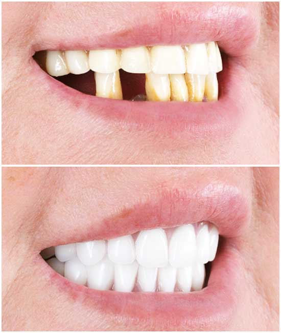 before and after dental photos