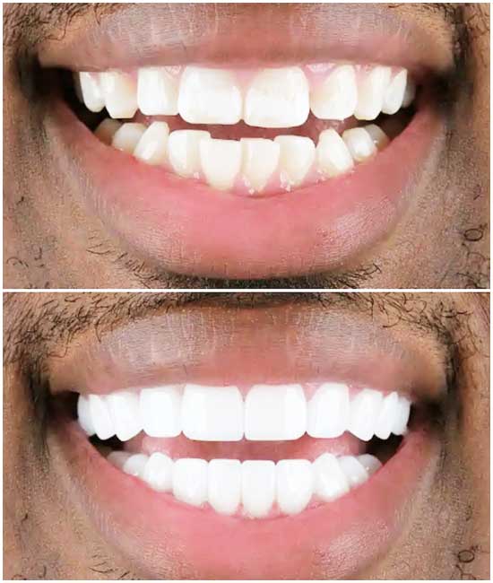 before and after dental photos