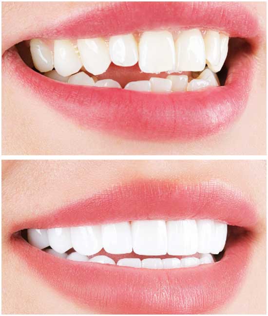 before and after dental photos