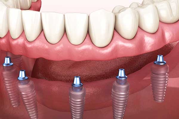 dental implants turkey cost