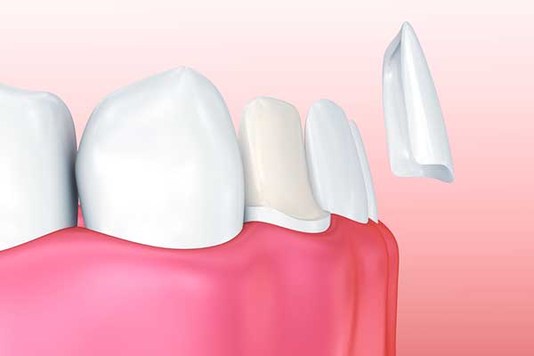 dental veneers turkey