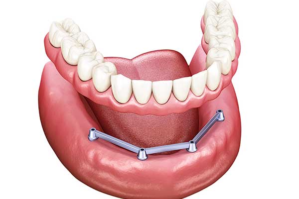 full mouth dental implants cost turkey