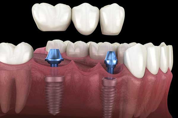 full mouth dental implants turkey package deals reviews