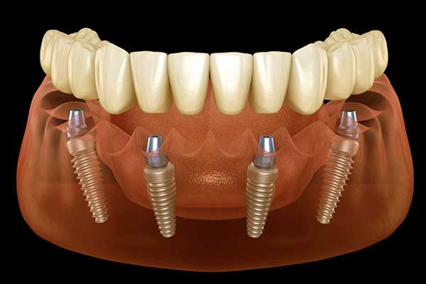 All on 4 Dental Implants in Turkey