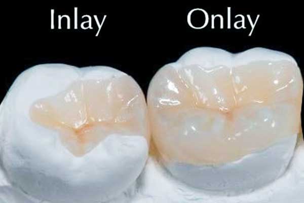 inlay dental in turkey