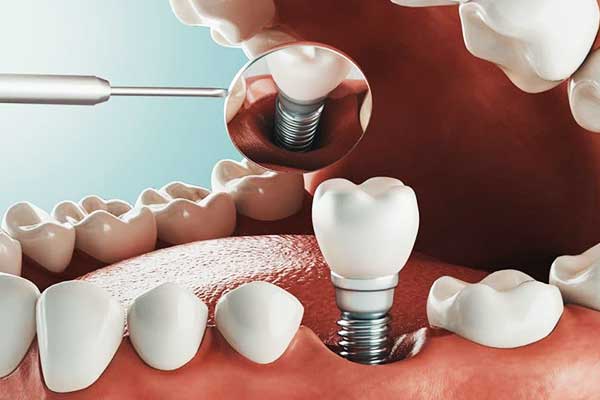 istanbul dental implants price