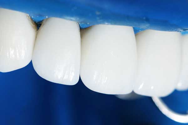 Transform Your Smile with Lumineers Teeth Turkey: 10 Key Benefits and Considerations