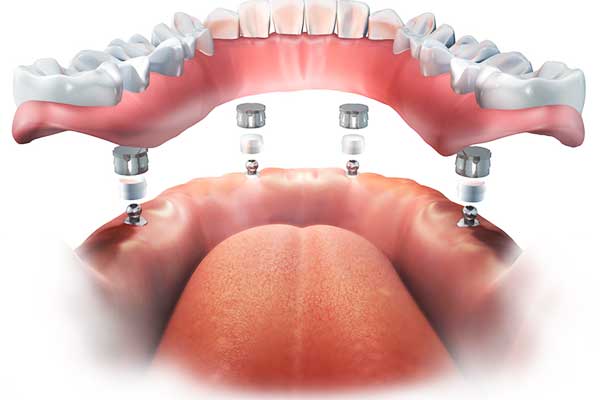 permanent dentures turkey