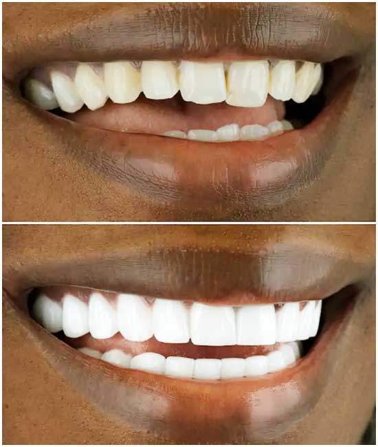 before and after dental photos