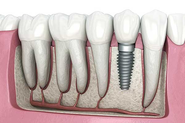 teeth replacement turkey