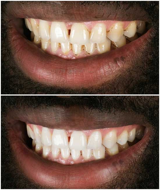 before and after dental photos