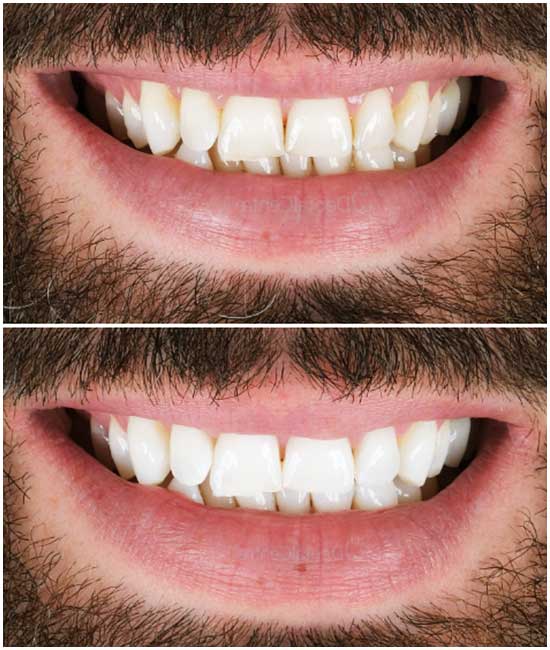 before and after dental photos