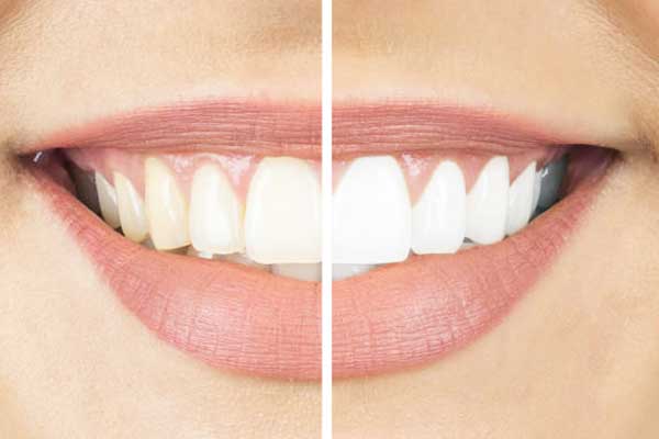 teeth whitening in turkey price