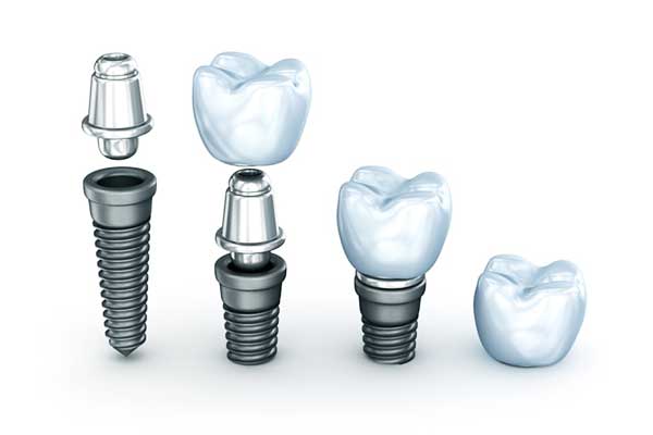 tooth implant turkey price