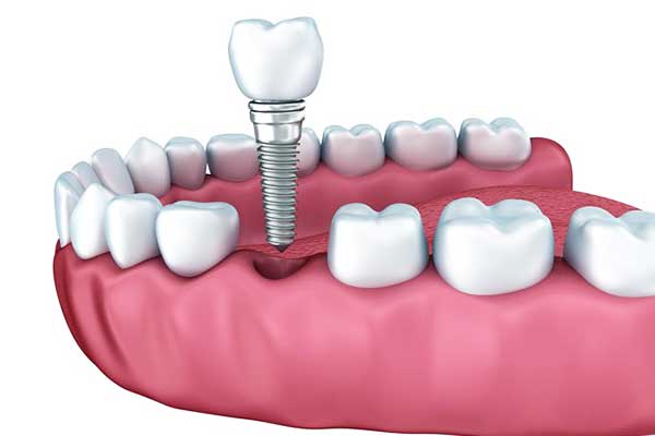 turkey teeth crowns