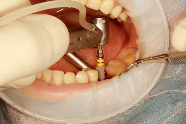 Zirconium Implant Treatment in Turkey