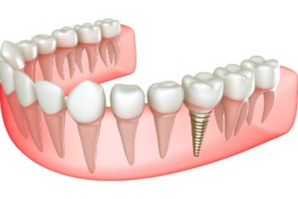 3 on 6 dental implants turkey