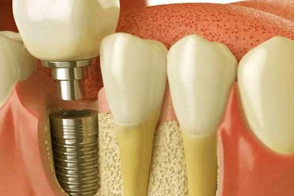 Dental Surgery in Turkey