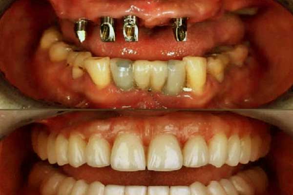 All on 6 Dental Implants in Turkey