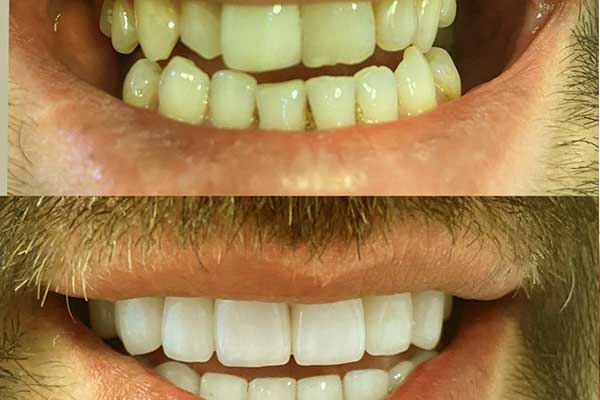 Teeth Whitening in Turkey