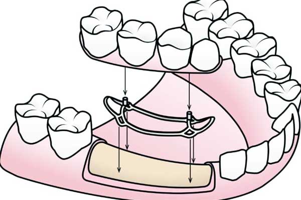 subperiosteal implants in turkey