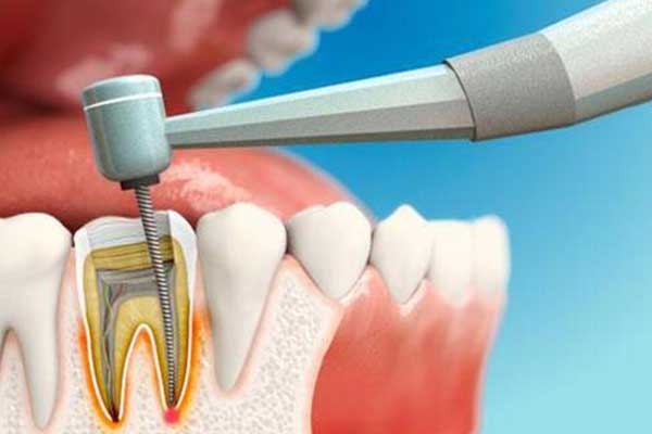 Endodoncia