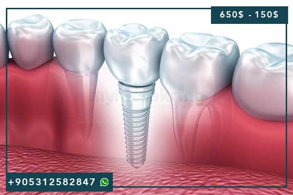 Prix du sourire Hollywoodien en Turquie, sourire Hollywoodien Turquie, facettes dentaires Turquie, blanchiment dents Turquie, tourisme dentaire Turquie, coût sourire Hollywoodien, forfait tout compris dents, facettes porcelaine, facettes zircone, E-max, clinique dentaire Turquie, soins dentaires Turquie