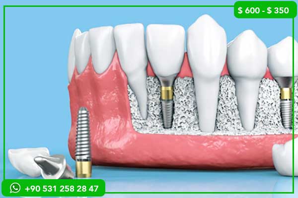 meilleure clinique dentaire en Turquie, implants dentaires Turquie, All-on-4 Turquie, All-on-6 Turquie, tourisme dentaire Turquie, soins dentaires Istanbul, prothèses dentaires Turquie, cliniques dentaires Istanbul, prix implants dentaires, chirurgie guidée dentaire, dentiste francophone Turquie, packages dentaires tout compris