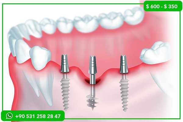 meilleur dentiste en Turquie, dentiste Turquie, tourisme dentaire Turquie, implants dentaires Turquie, facettes dentaires Turquie, blanchiment dents Turquie, orthodontie Turquie, clinique dentaire Turquie, soins dentaires Turquie, dentisterie esthétique Turquie