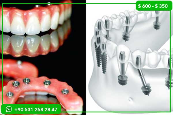prix des traitements dentaires en Turquie, soins dentaires Turquie, tourisme dentaire Turquie, implants dentaires Turquie, couronnes dentaires Turquie, facettes dentaires Turquie, blanchiment dents Turquie, économies soins dentaires, clinique dentaire Turquie, voyage dentaire Turquie