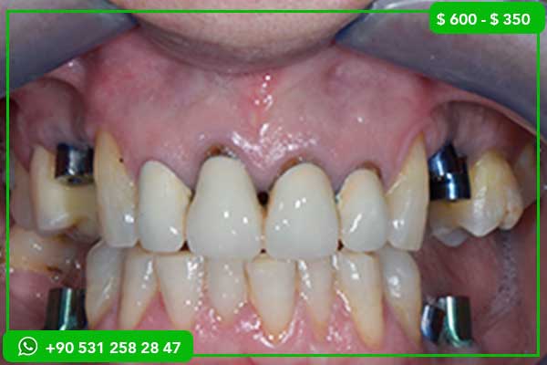 prix appareil dentaire Turquie, orthodontie Turquie, appareil dentaire pas cher, aligneurs Turquie, brackets métalliques Turquie, brackets céramiques Turquie, brackets linguals Turquie, tourisme dentaire Turquie, soins dentaires Turquie, clinique dentaire Turquie, tarifs orthodontie Turquie