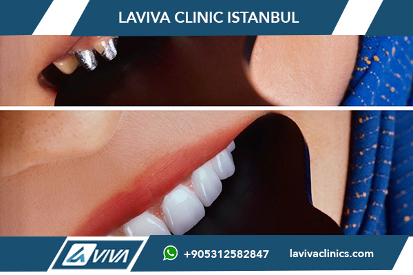 Sorriso alla Hollywood