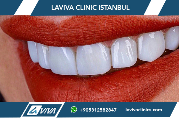 Arten von Zahnveneers