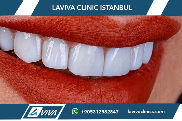 Carillas dentales en Turquía