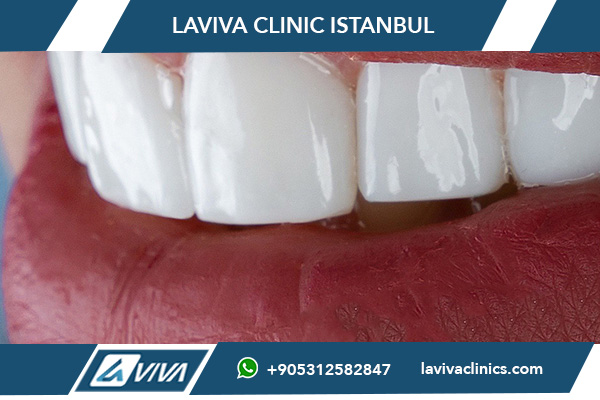 Cura delle faccette dentali