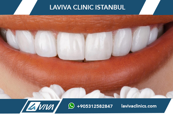 Cómo elegir el color adecuado de las carillas dentales para ti