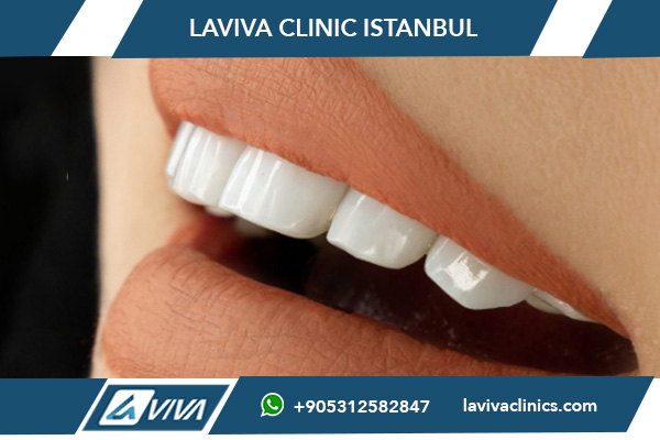 Wie man die passende Farbe für Zahnveneers auswählt