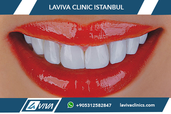 Cuidado de las carillas dentales