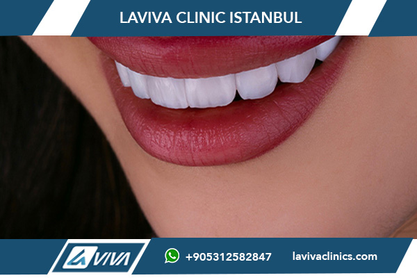 Sonrisa de Hollywood