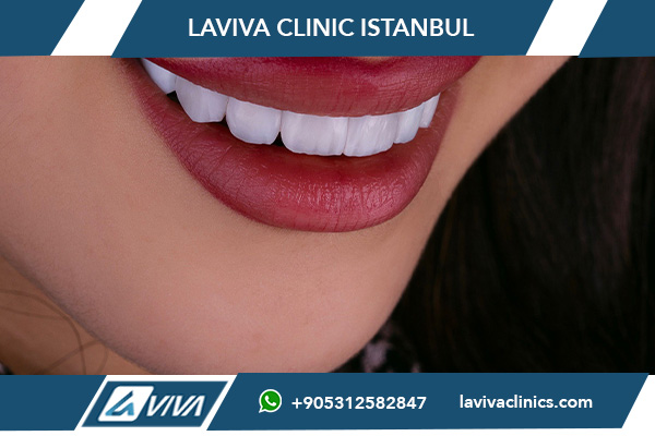 Zahnveneers in der Türkei