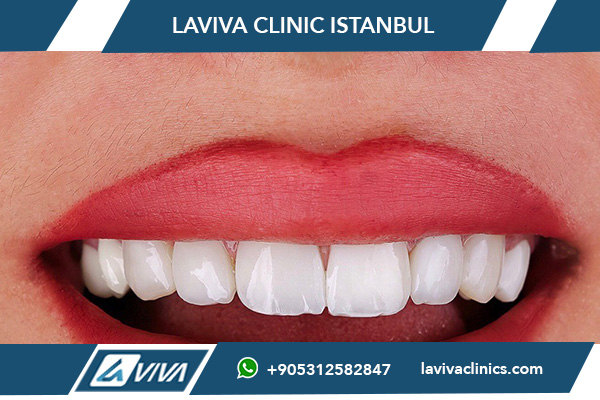 Виды зубных имплантов