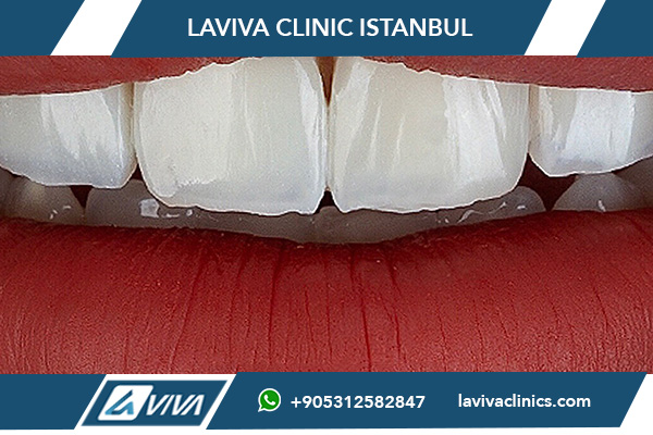 Mejor dentista de implantes en Turquía